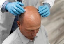 Hair Transplant Chicago