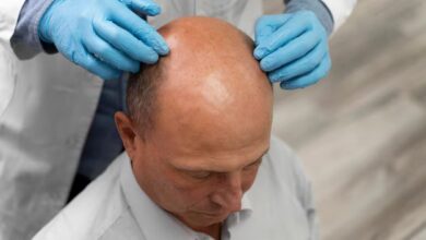 Hair Transplant Chicago